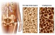 bone density